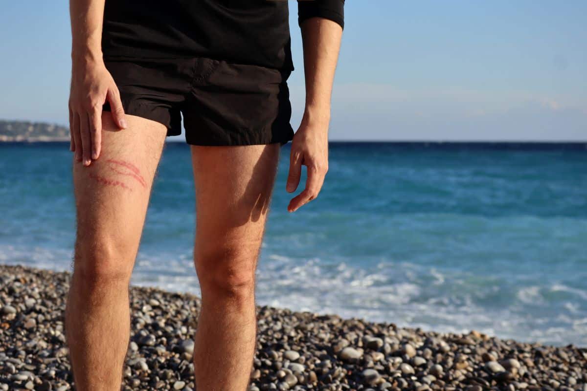 Uomo con puntura di medusa sulla gamba