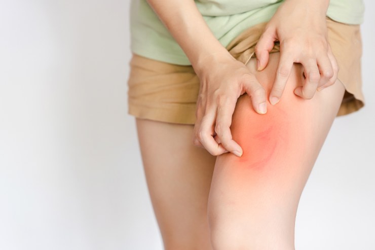 Una persona con la gamba rossa per via di un allergia e che si gratta